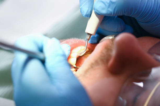 Best Emergency Treatment for Dental Infections or Abscesses in Saint Johns University, MN