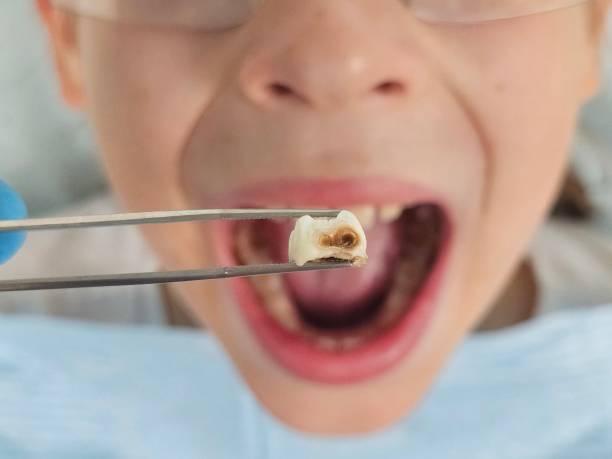 Best Emergency Dental Care for Broken or Chipped Teeth in Saint Johns University, MN