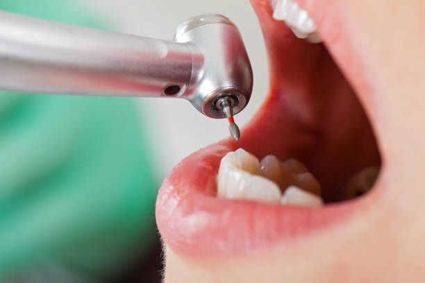 Best Emergency Wisdom Teeth Removal in Saint Johns University, MN